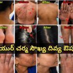 అన్ని రకాల చర్మ సమస్యలకు శాశ్వత పరిష్కారం…