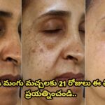 మొండి మంగు మచ్చలకు 21 రోజులు ఈ చిట్కా ప్రయత్నించండి…