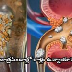 మూత్రపిండాల్లో రాళ్లు ఉన్నాయా?